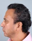 After Hair Transplant&nbsp;Front